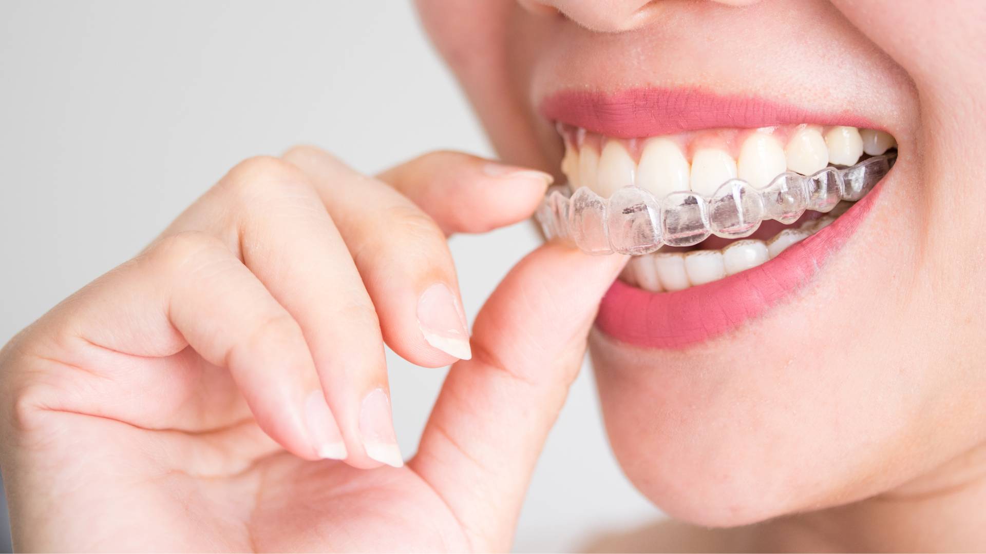 Aligner Behandlung