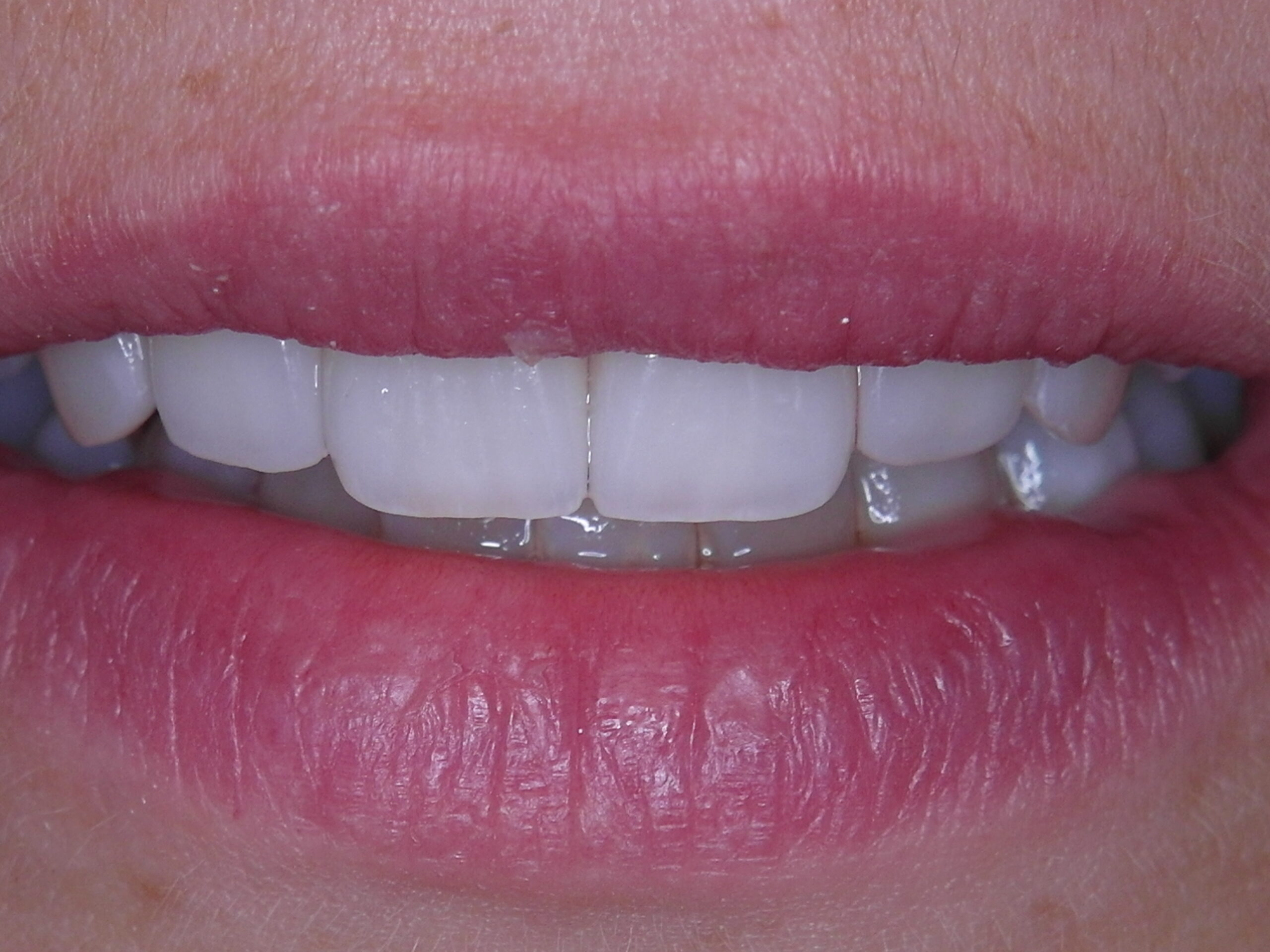 Aligner
